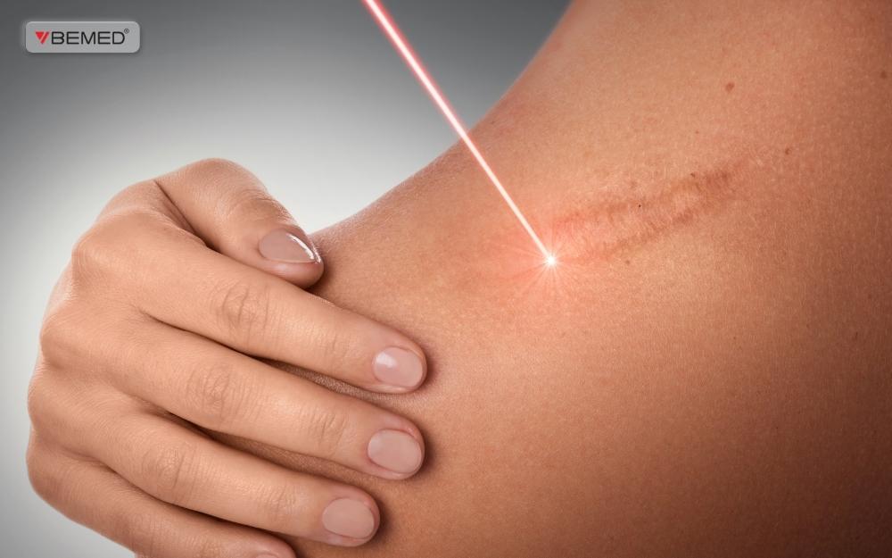 Laser tái tạo da phân đoạn